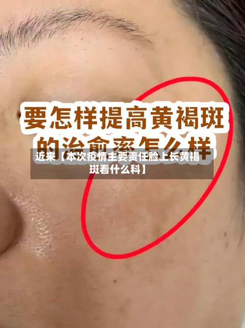 近来【本次疫情主要责任脸上长黄褐斑看什么科】-第1张图片